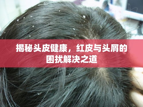 揭秘頭皮健康，紅皮與頭屑的困擾解決之道